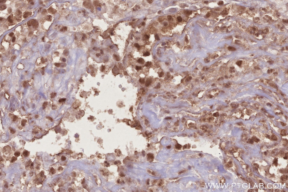Immunohistochemistry (IHC) staining of human ovary cancer tissue using NEK7 Polyclonal antibody (31422-1-AP)