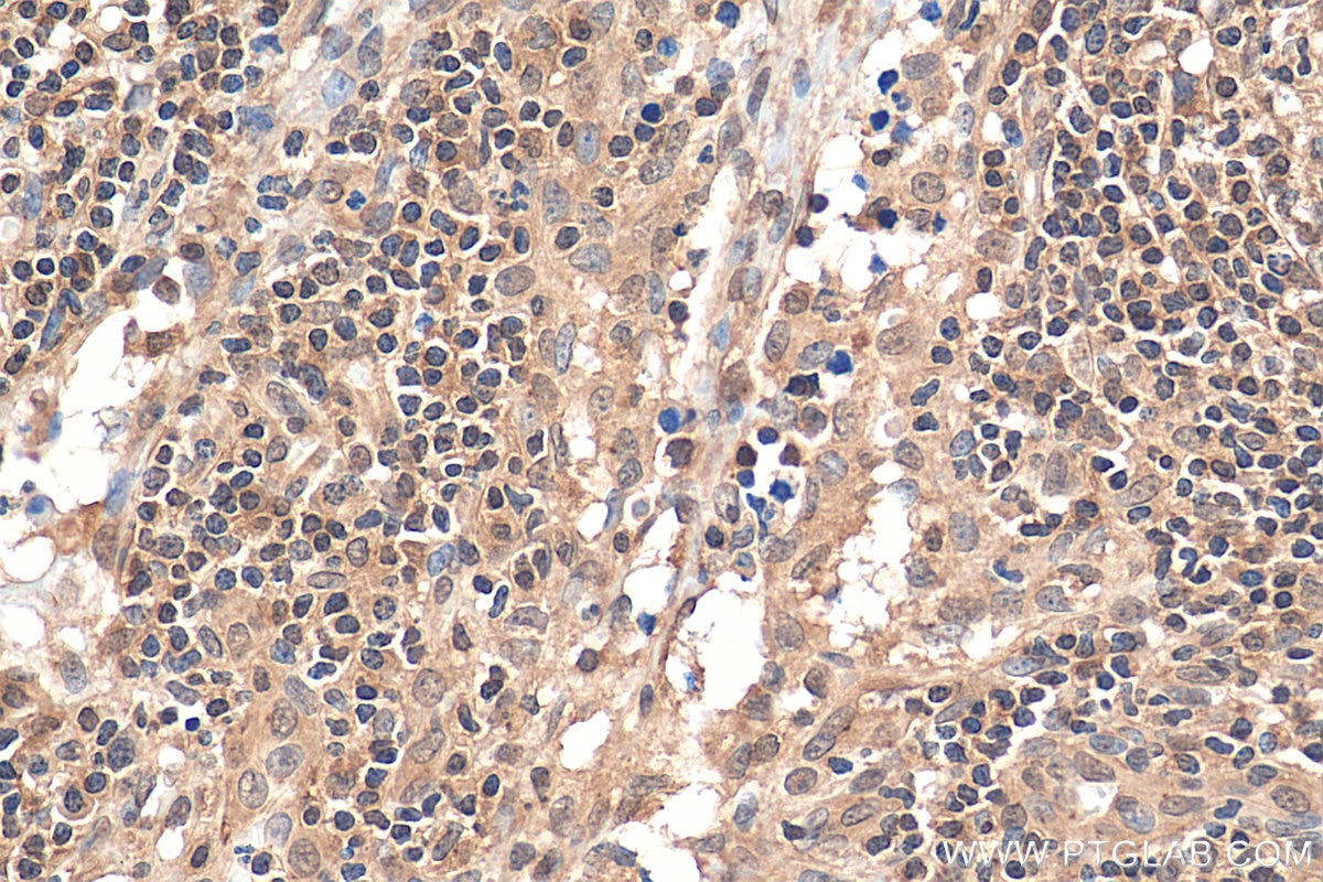 Immunohistochemistry (IHC) staining of human lymphoma tissue using NEK9 Polyclonal antibody (11192-1-AP)