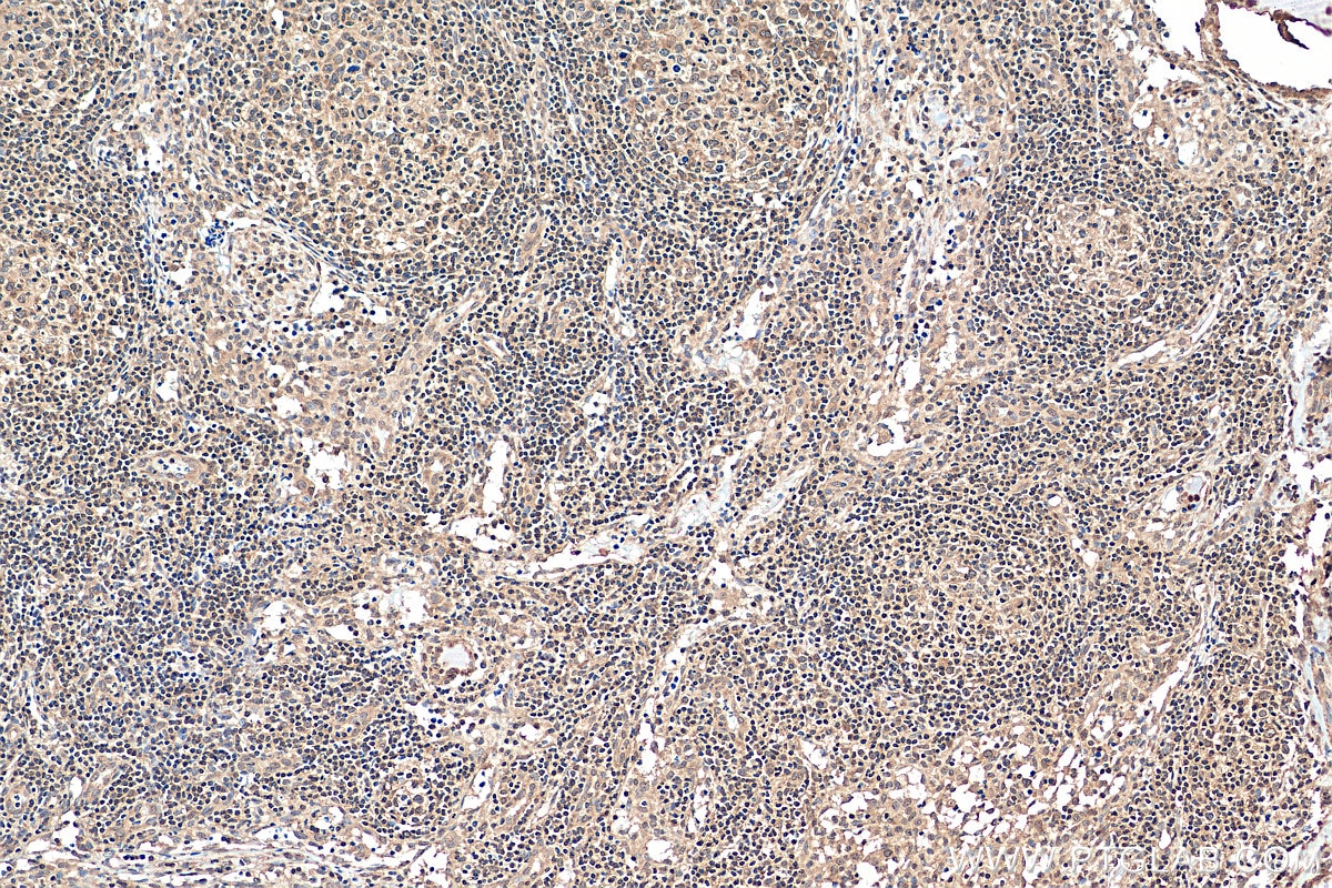 Immunohistochemistry (IHC) staining of human lymphoma tissue using NEK9 Polyclonal antibody (11192-1-AP)