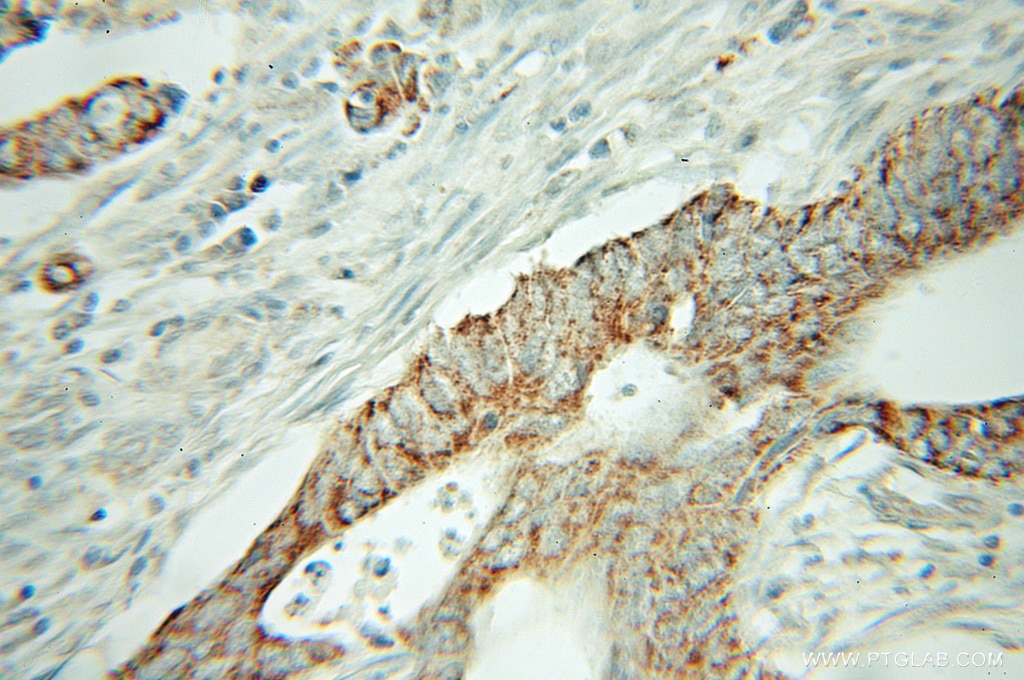 Immunohistochemistry (IHC) staining of human colon cancer tissue using NELF Polyclonal antibody (12244-1-AP)