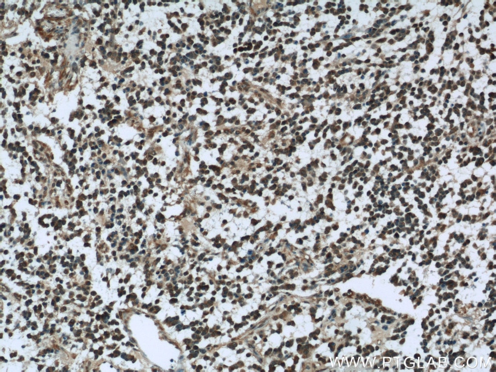 Immunohistochemistry (IHC) staining of human gliomas tissue using Nestin Polyclonal antibody (19483-1-AP)