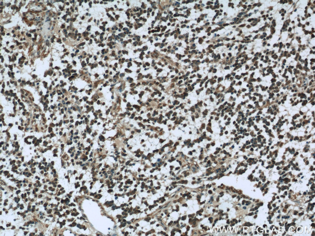 IHC staining of human gliomas using 19483-1-AP