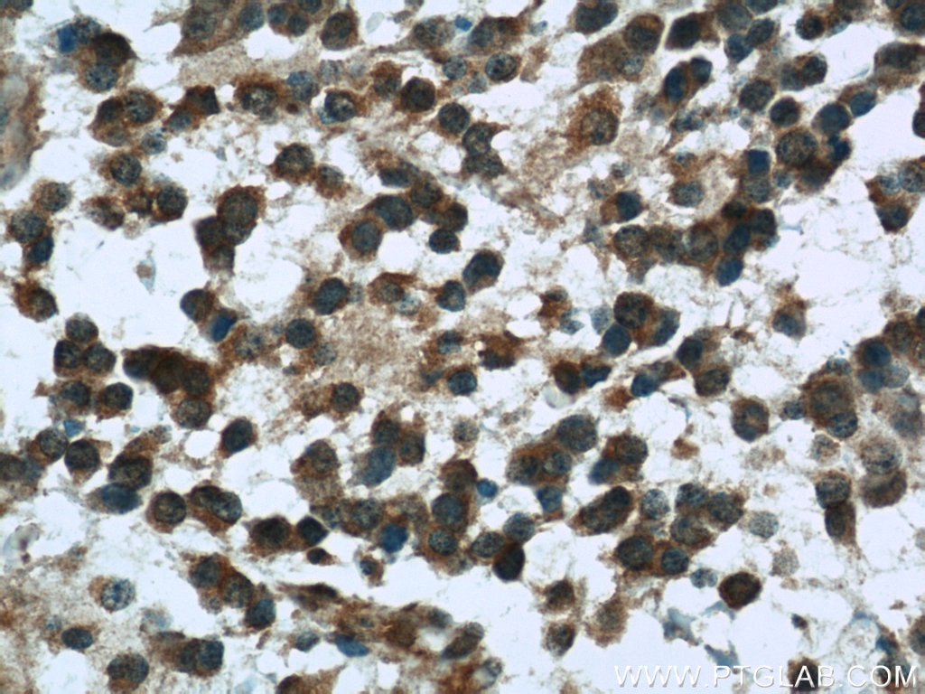 Immunohistochemistry (IHC) staining of human gliomas tissue using Nestin Polyclonal antibody (19483-1-AP)