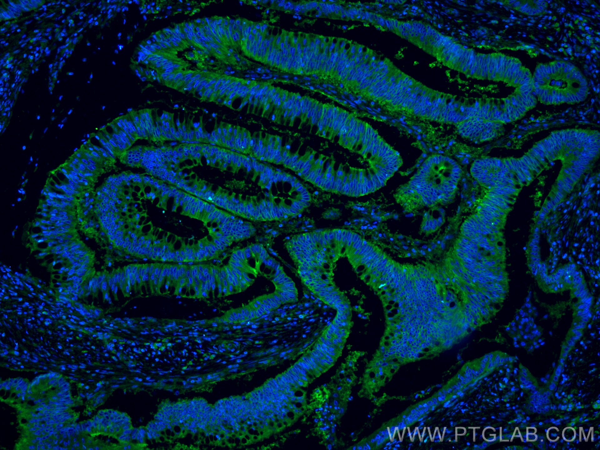 Immunofluorescence (IF) / fluorescent staining of human colon cancer tissue using GNAS Monoclonal antibody (66253-1-Ig)