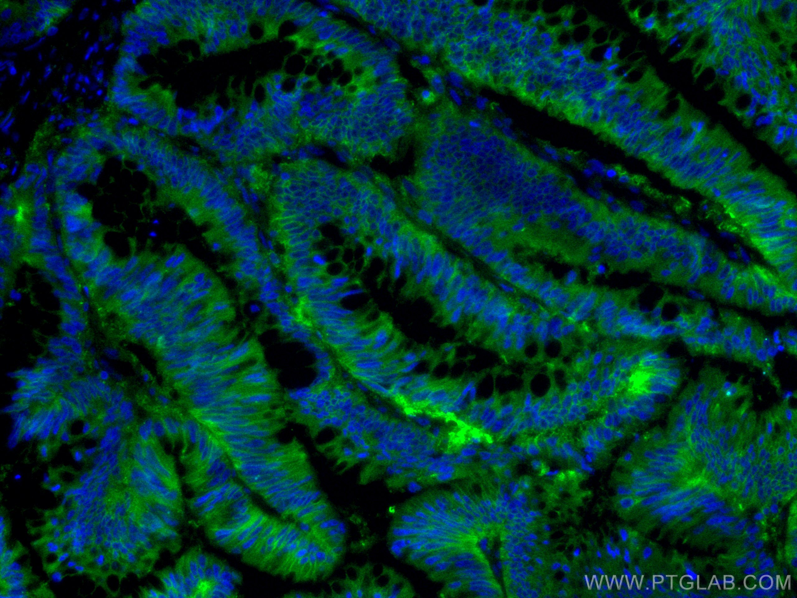 Immunofluorescence (IF) / fluorescent staining of human colon cancer tissue using GNAS Monoclonal antibody (66253-1-Ig)