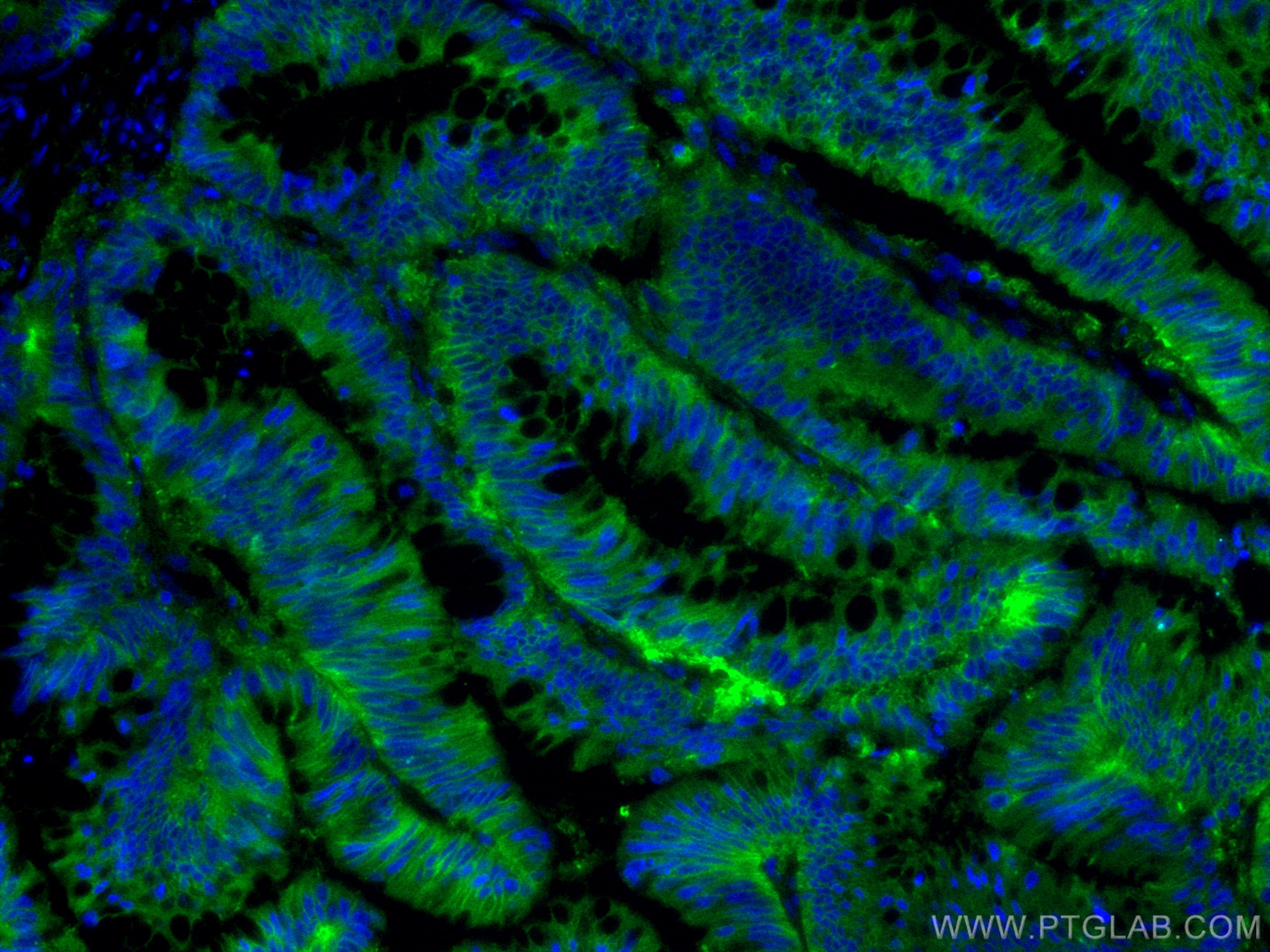 IF Staining of human colon cancer using 66253-1-Ig