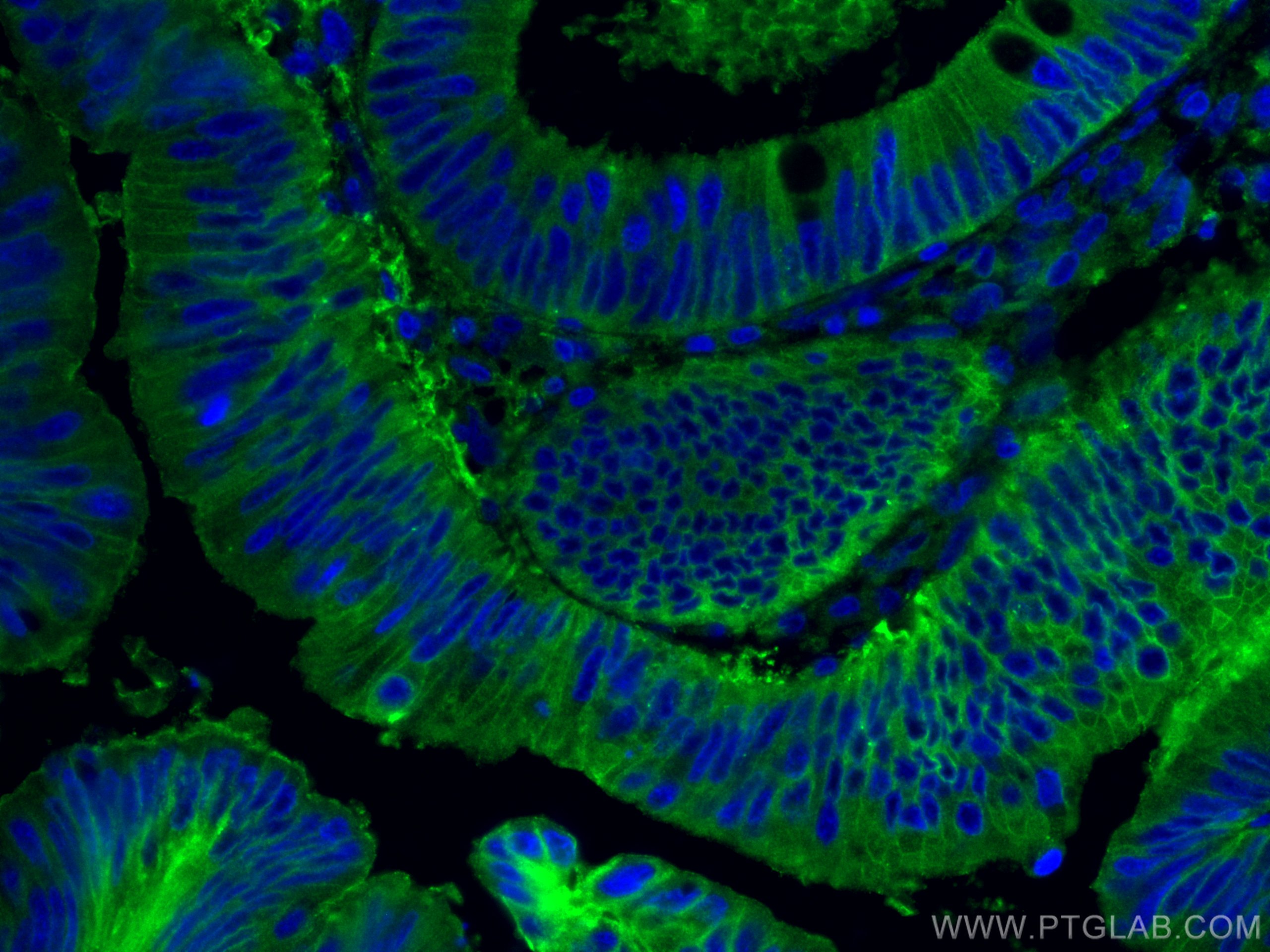 Immunofluorescence (IF) / fluorescent staining of human colon cancer tissue using GNAS Monoclonal antibody (66253-1-Ig)