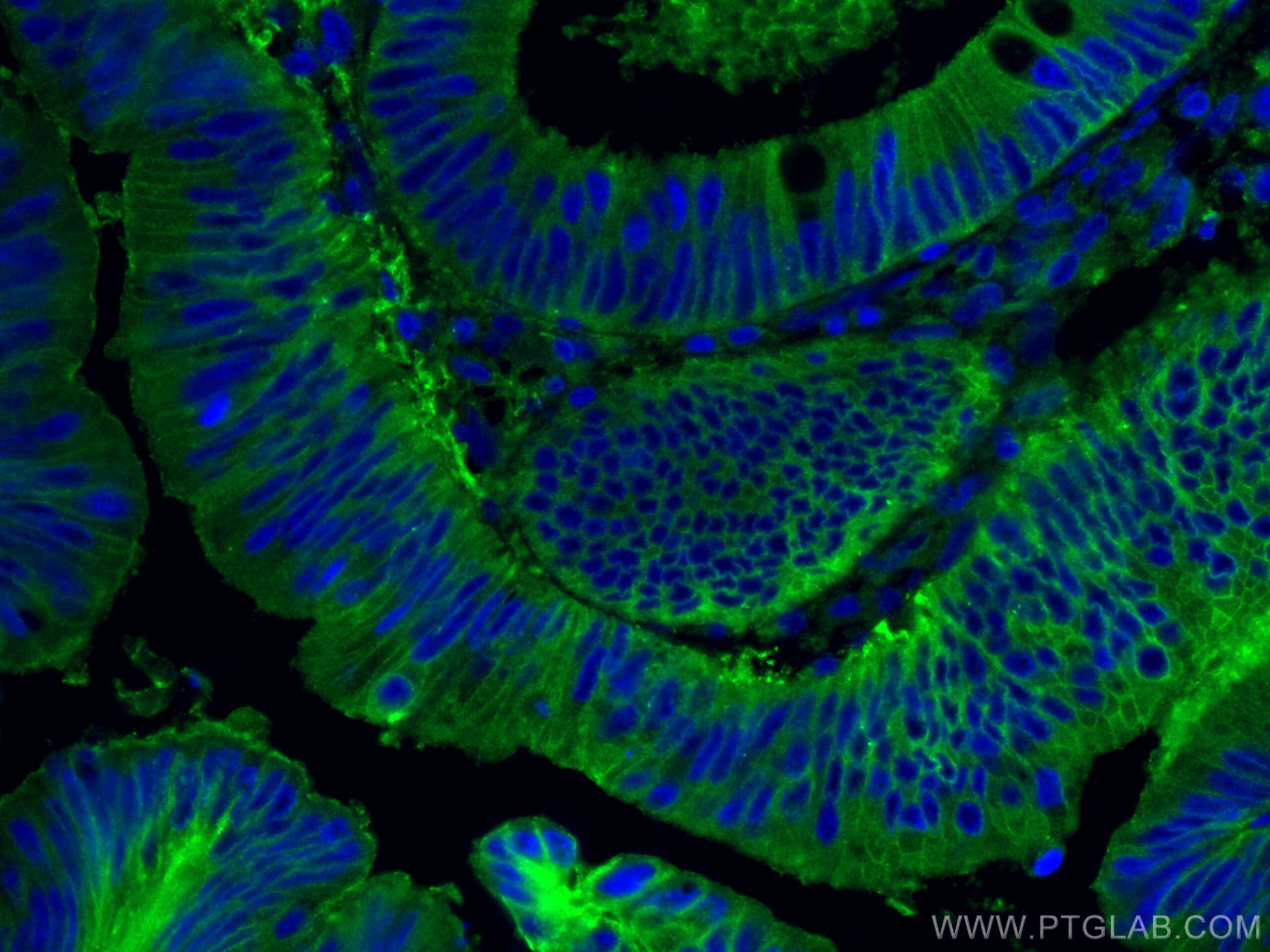 IF Staining of human colon cancer using 66253-1-Ig