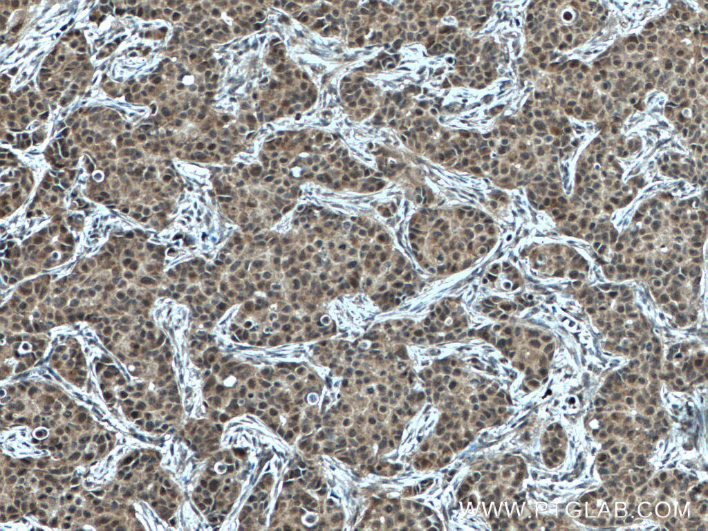 Immunohistochemistry (IHC) staining of human breast cancer tissue using NET1 Polyclonal antibody (28180-1-AP)