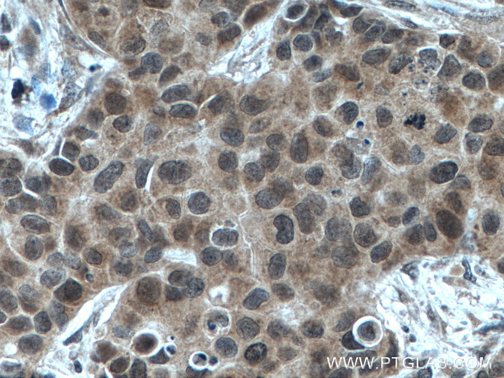 Immunohistochemistry (IHC) staining of human breast cancer tissue using NET1 Polyclonal antibody (28180-1-AP)