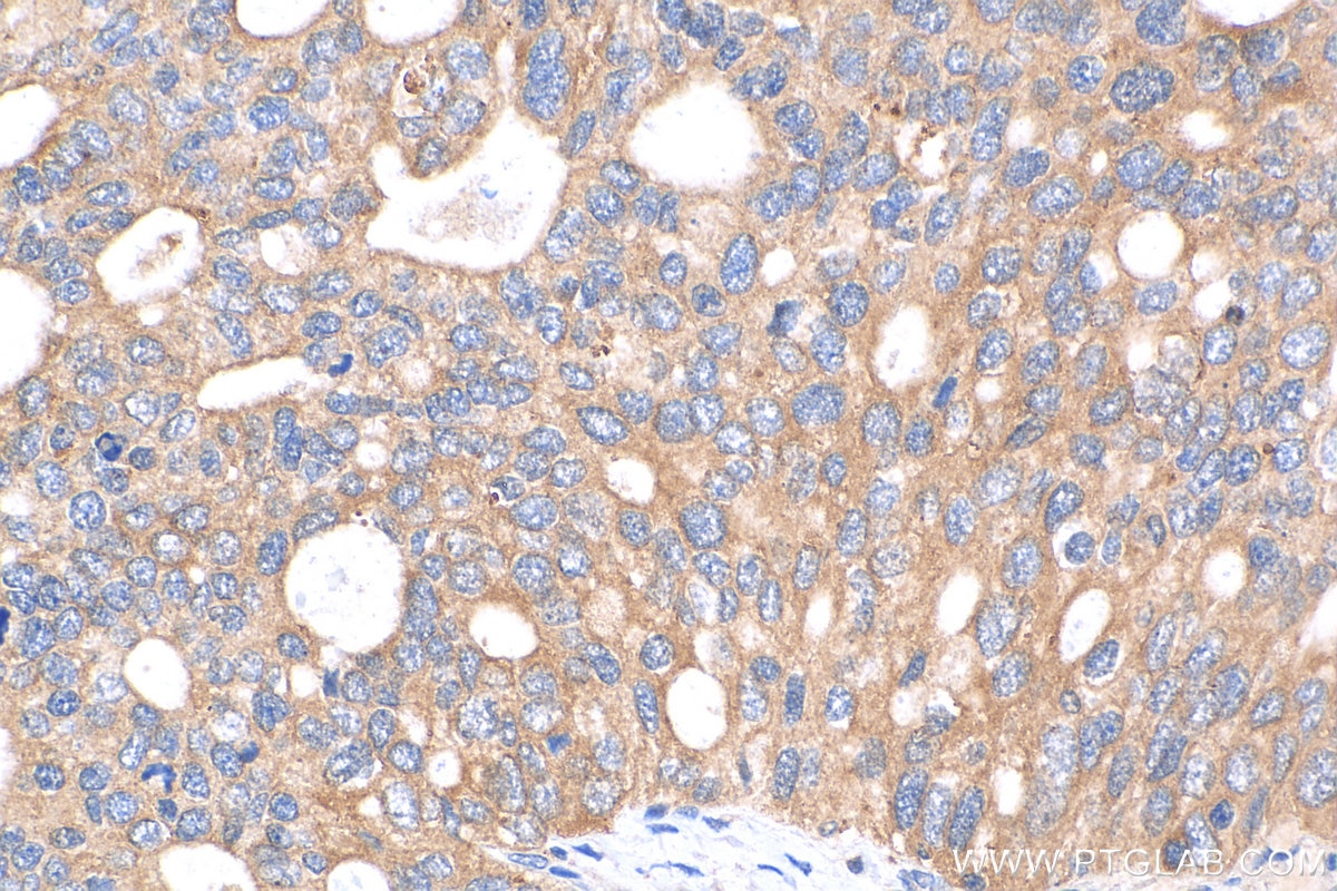 Immunohistochemistry (IHC) staining of human ovary tumor tissue using NETO1 Polyclonal antibody (29936-1-AP)