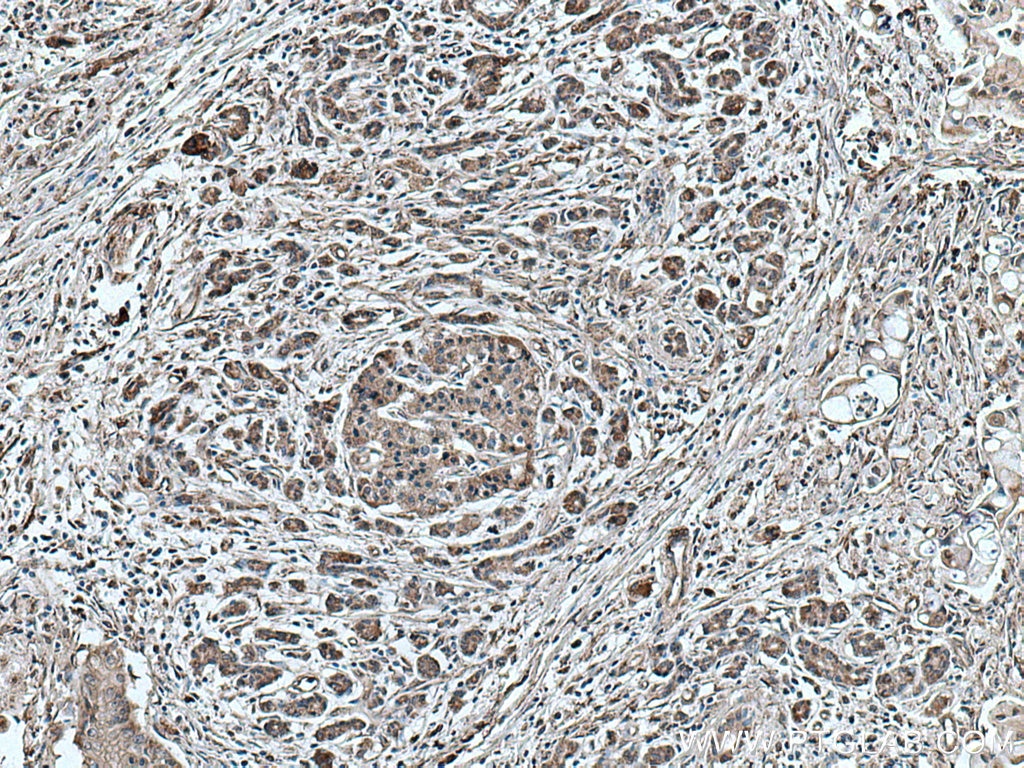 IHC staining of human pancreas cancer using 67032-1-Ig