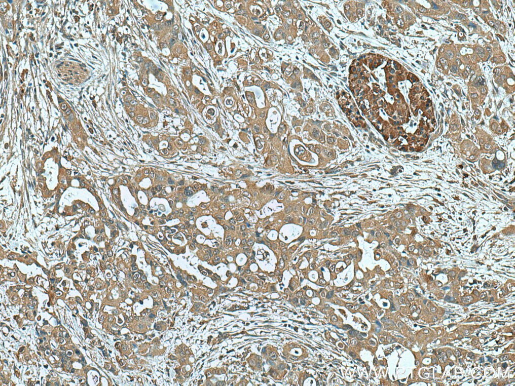 Immunohistochemistry (IHC) staining of human pancreas cancer tissue using NEU3 Monoclonal antibody (67098-1-Ig)
