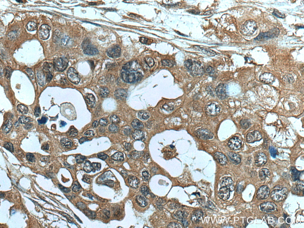 Immunohistochemistry (IHC) staining of human pancreas cancer tissue using NEU3 Monoclonal antibody (67098-1-Ig)