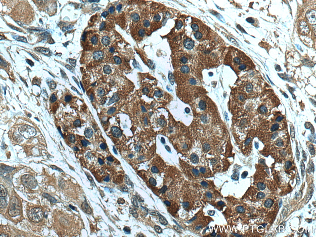 Immunohistochemistry (IHC) staining of human pancreas cancer tissue using NEU3 Monoclonal antibody (67098-1-Ig)
