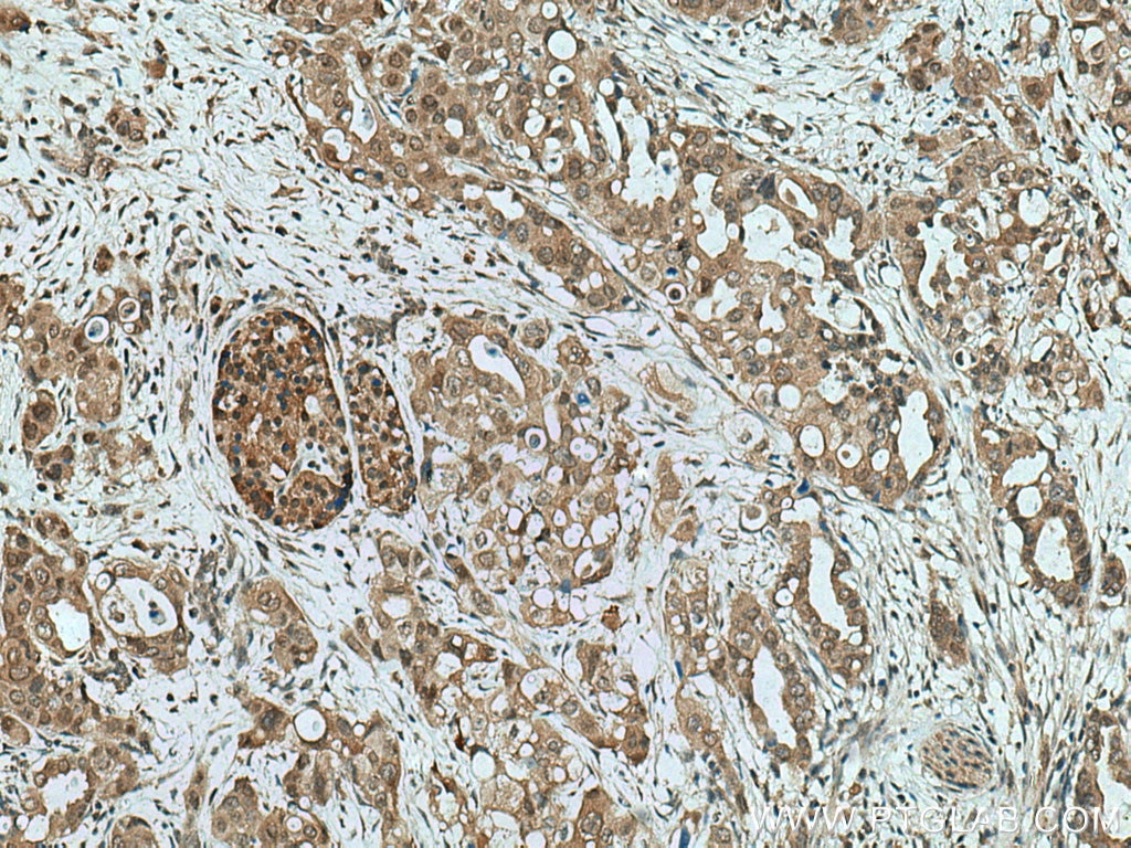 Immunohistochemistry (IHC) staining of human pancreas cancer tissue using NEUROD1 Polyclonal antibody (12081-1-AP)