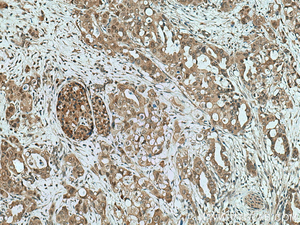 IHC staining of human pancreas cancer using 12081-1-AP