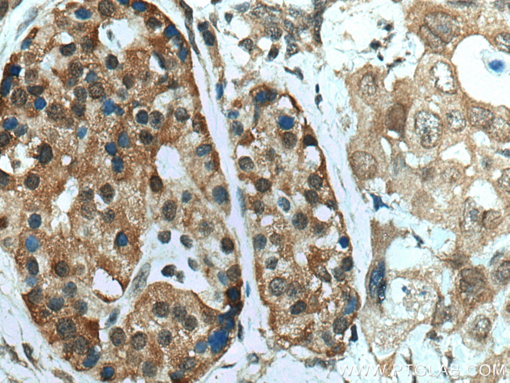 IHC staining of human pancreas cancer using 12081-1-AP