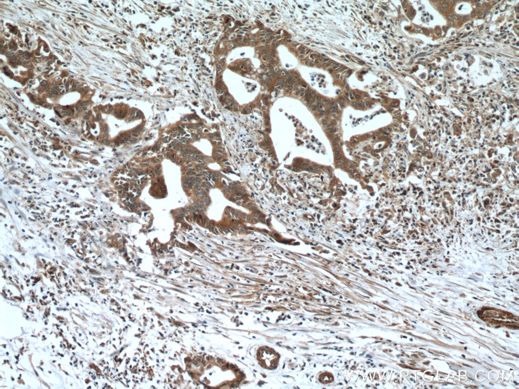 Immunohistochemistry (IHC) staining of human pancreas cancer tissue using NEUROD1 Monoclonal antibody (66691-1-Ig)