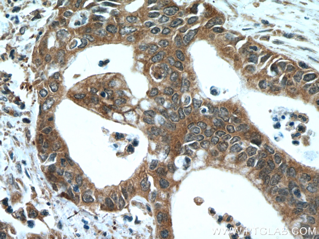 Immunohistochemistry (IHC) staining of human pancreas cancer tissue using NEUROD1 Monoclonal antibody (66691-1-Ig)