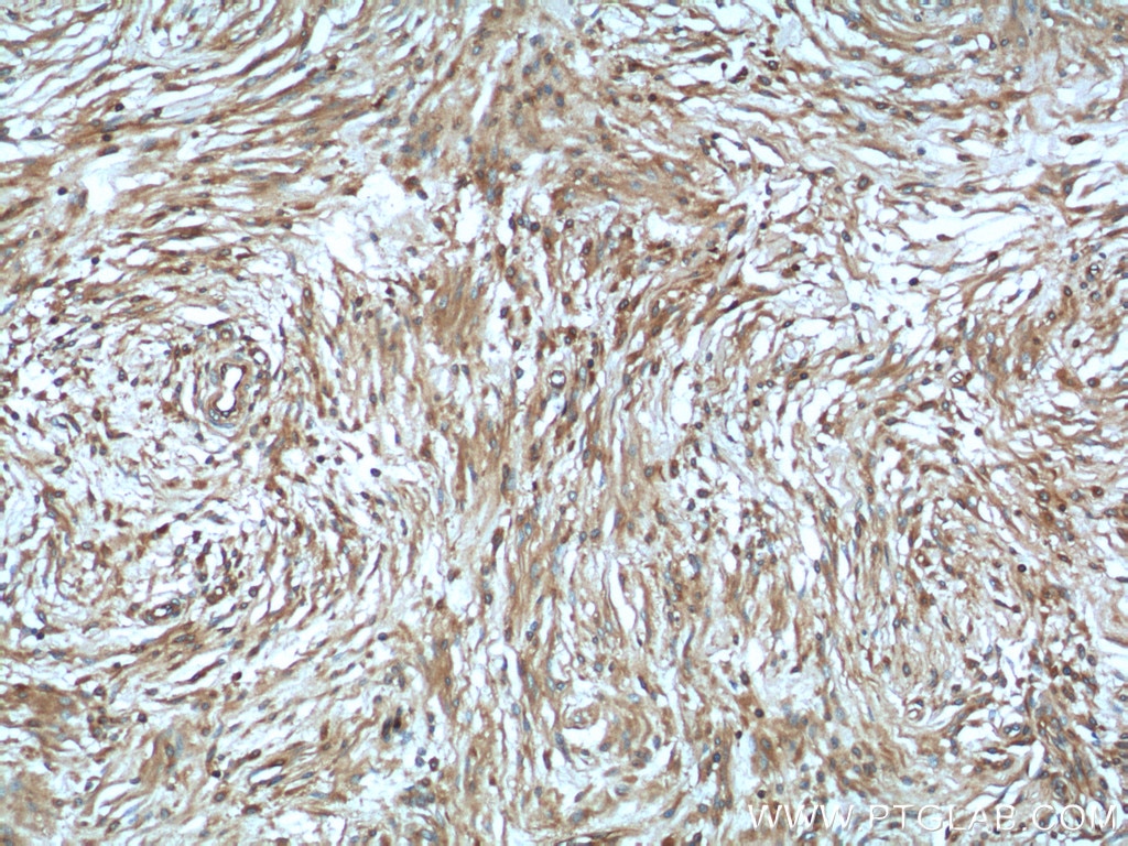 Immunohistochemistry (IHC) staining of human meningioma tissue using NF2 Polyclonal antibody (21686-1-AP)