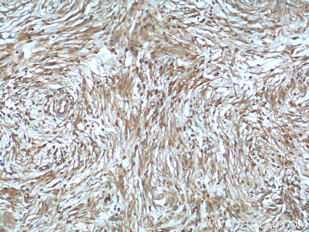 IHC staining of human meningioma using 21686-1-AP