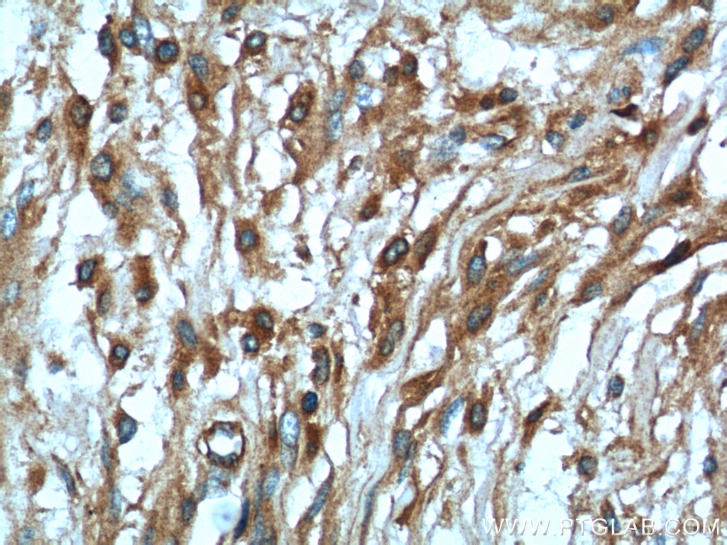 Immunohistochemistry (IHC) staining of human meningioma tissue using NF2 Polyclonal antibody (21686-1-AP)