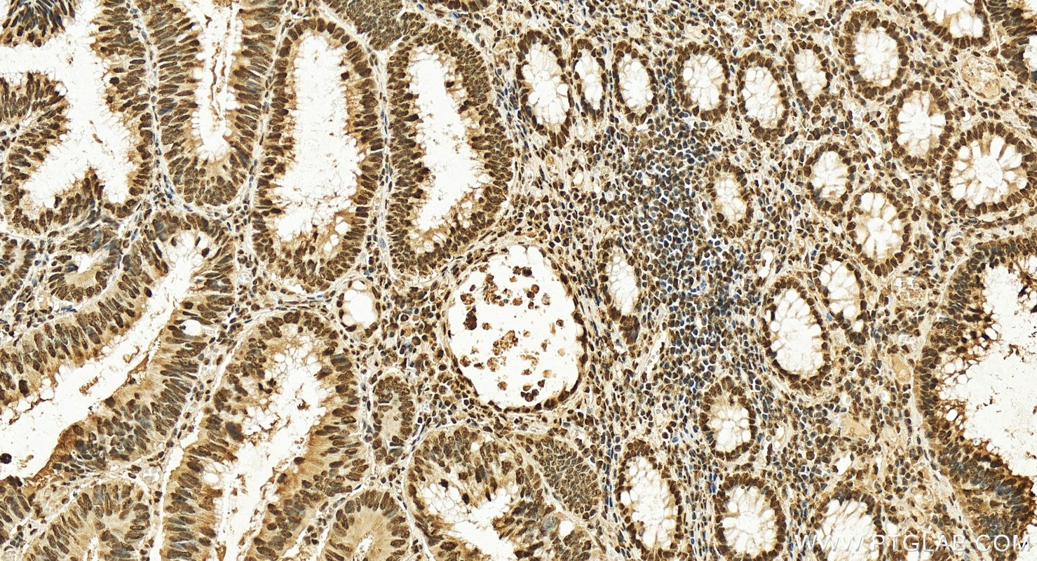 Immunohistochemistry (IHC) staining of human colon cancer tissue using NF45 Polyclonal antibody (14714-1-AP)