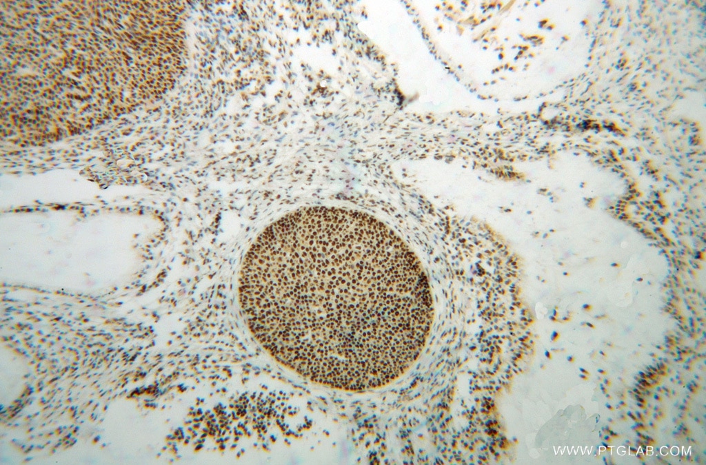 Immunohistochemistry (IHC) staining of human cervical cancer tissue using NF45 Polyclonal antibody (14714-1-AP)
