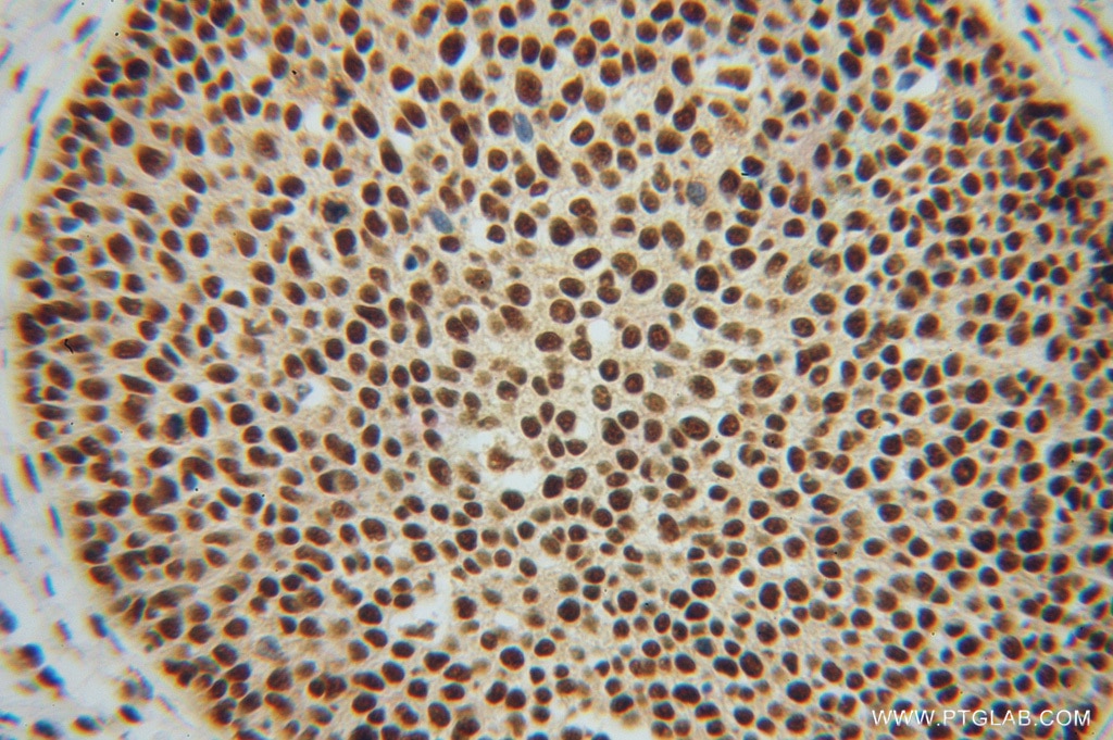 Immunohistochemistry (IHC) staining of human cervical cancer tissue using NF45 Polyclonal antibody (14714-1-AP)