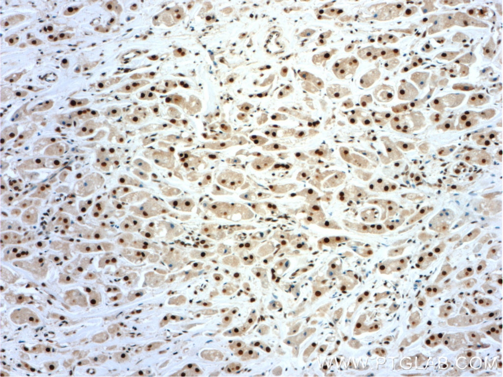 Immunohistochemistry (IHC) staining of human breast cancer tissue using NF45 Polyclonal antibody (24572-1-AP)
