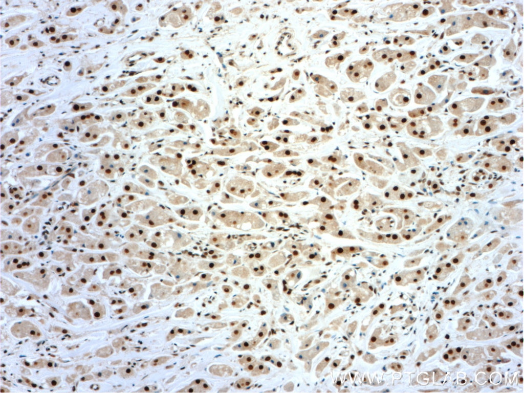 IHC staining of human breast cancer using 24572-1-AP