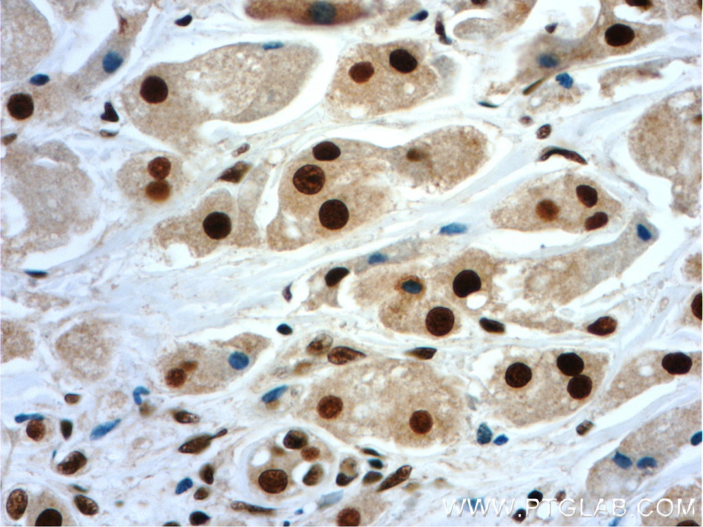 Immunohistochemistry (IHC) staining of human breast cancer tissue using NF45 Polyclonal antibody (24572-1-AP)