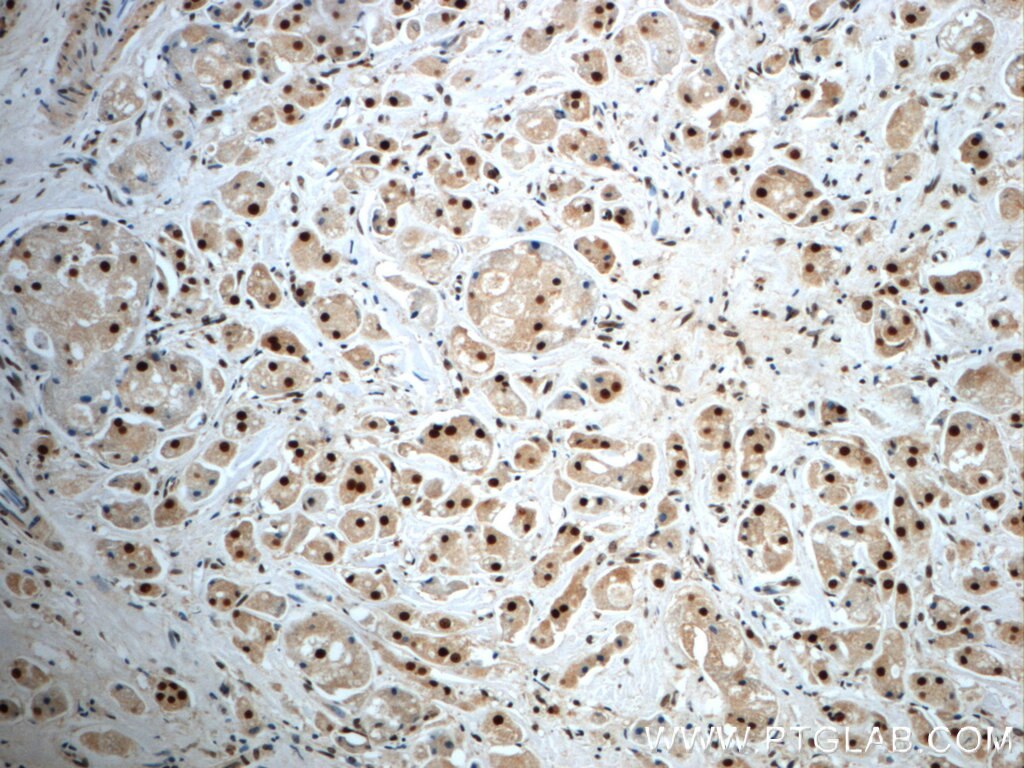 Immunohistochemistry (IHC) staining of human breast cancer tissue using NF45 Polyclonal antibody (24572-1-AP)