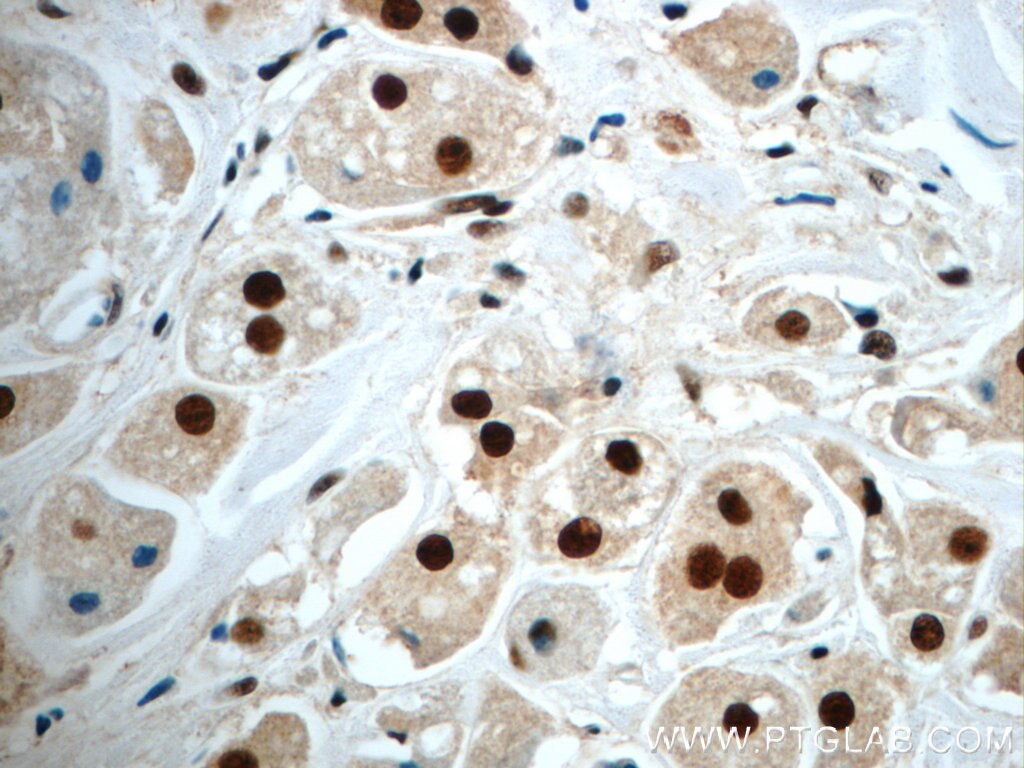 Immunohistochemistry (IHC) staining of human breast cancer tissue using NF45 Polyclonal antibody (24572-1-AP)