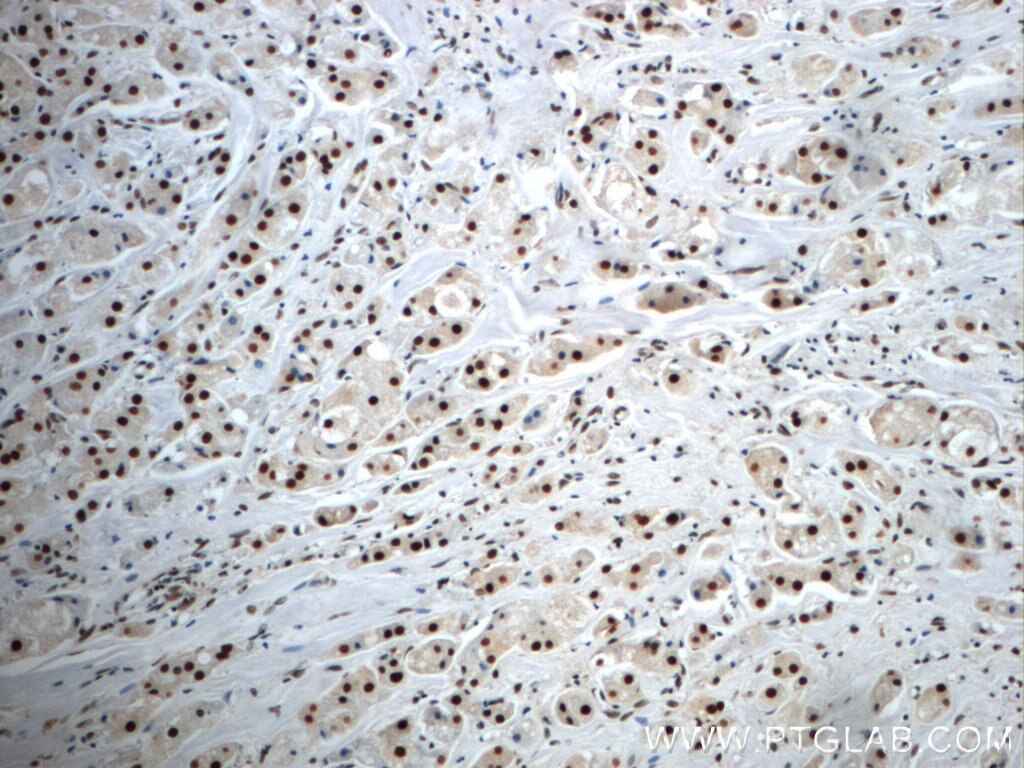 IHC staining of human breast cancer using 24572-1-AP
