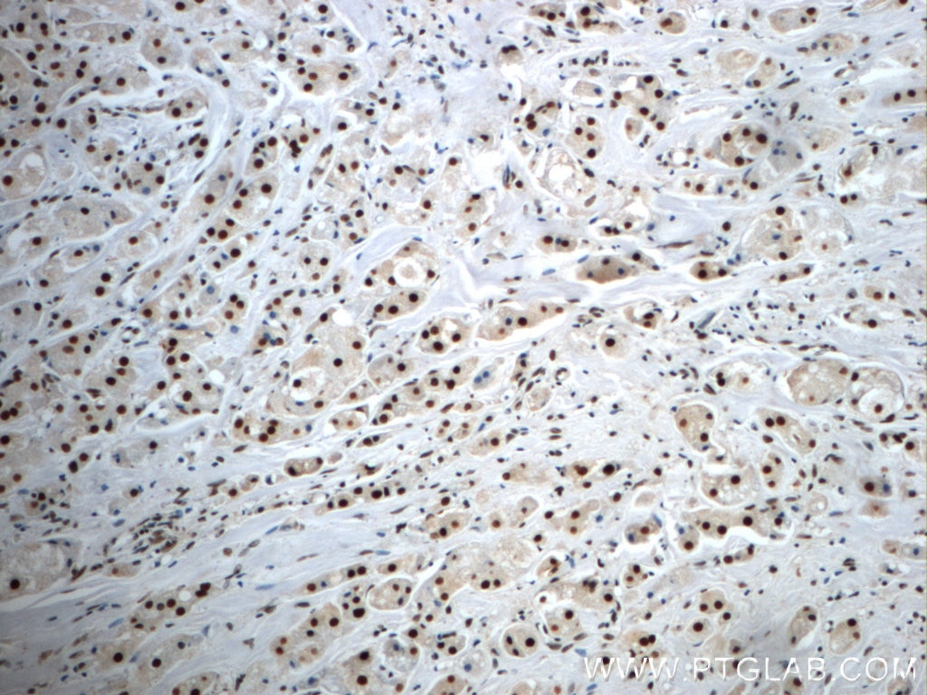 Immunohistochemistry (IHC) staining of human breast cancer tissue using NF45 Polyclonal antibody (24572-1-AP)