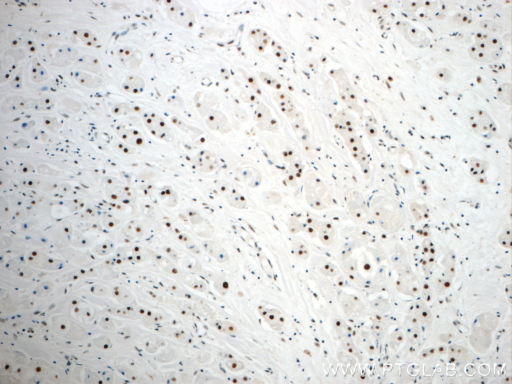 Immunohistochemistry (IHC) staining of human breast cancer tissue using NF45 Polyclonal antibody (24572-1-AP)