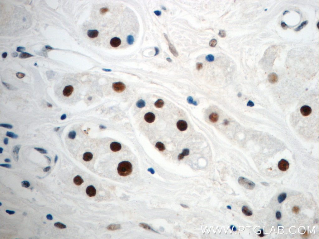 Immunohistochemistry (IHC) staining of human breast cancer tissue using NF45 Polyclonal antibody (24572-1-AP)