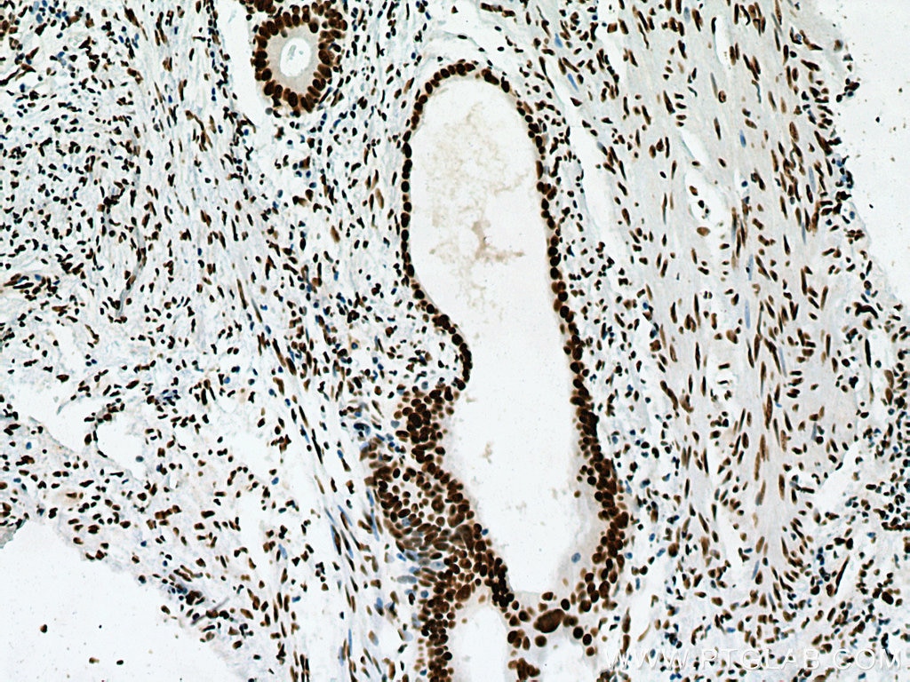 Immunohistochemistry (IHC) staining of human colon cancer tissue using NF45 Monoclonal antibody (67685-1-Ig)