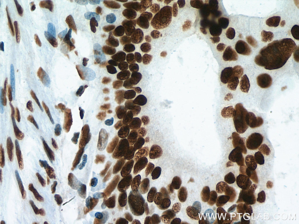 Immunohistochemistry (IHC) staining of human colon cancer tissue using NF45 Monoclonal antibody (67685-1-Ig)