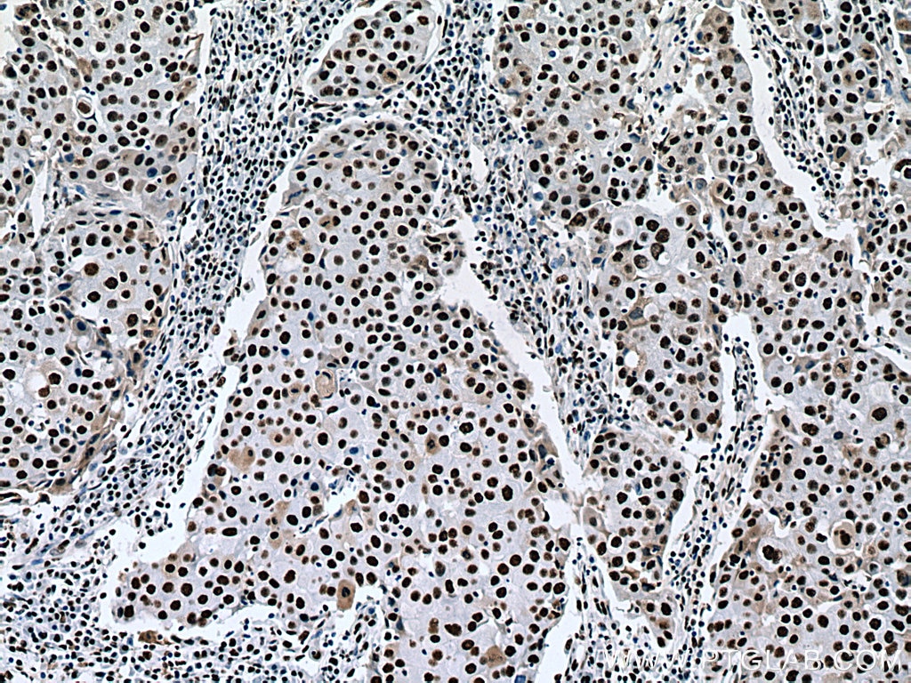 Immunohistochemistry (IHC) staining of human breast cancer tissue using NF45 Monoclonal antibody (67685-1-Ig)