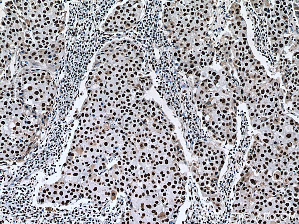 IHC staining of human breast cancer using 67685-1-Ig