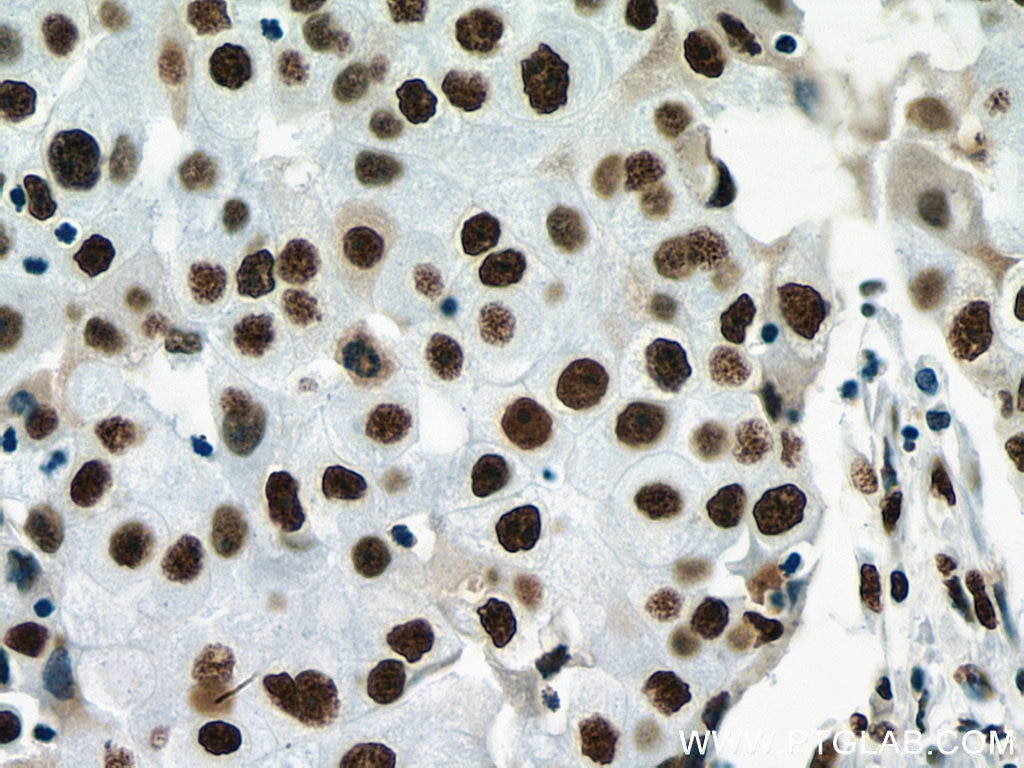 Immunohistochemistry (IHC) staining of human breast cancer tissue using NF45 Monoclonal antibody (67685-1-Ig)