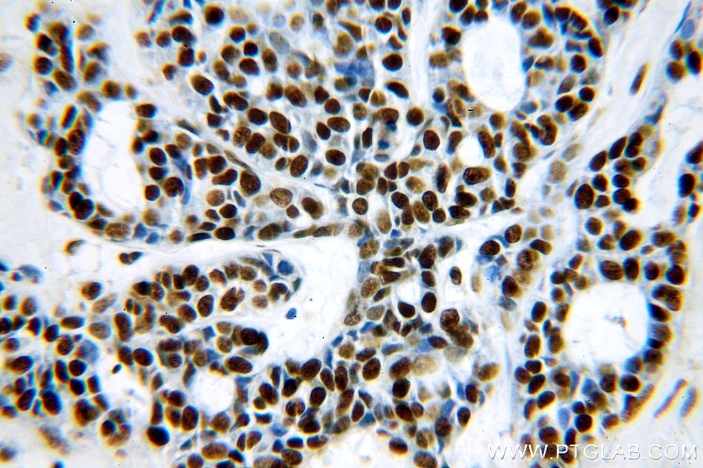 Immunohistochemistry (IHC) staining of human cervical cancer tissue using NF90/ILF3 Polyclonal antibody (19887-1-AP)
