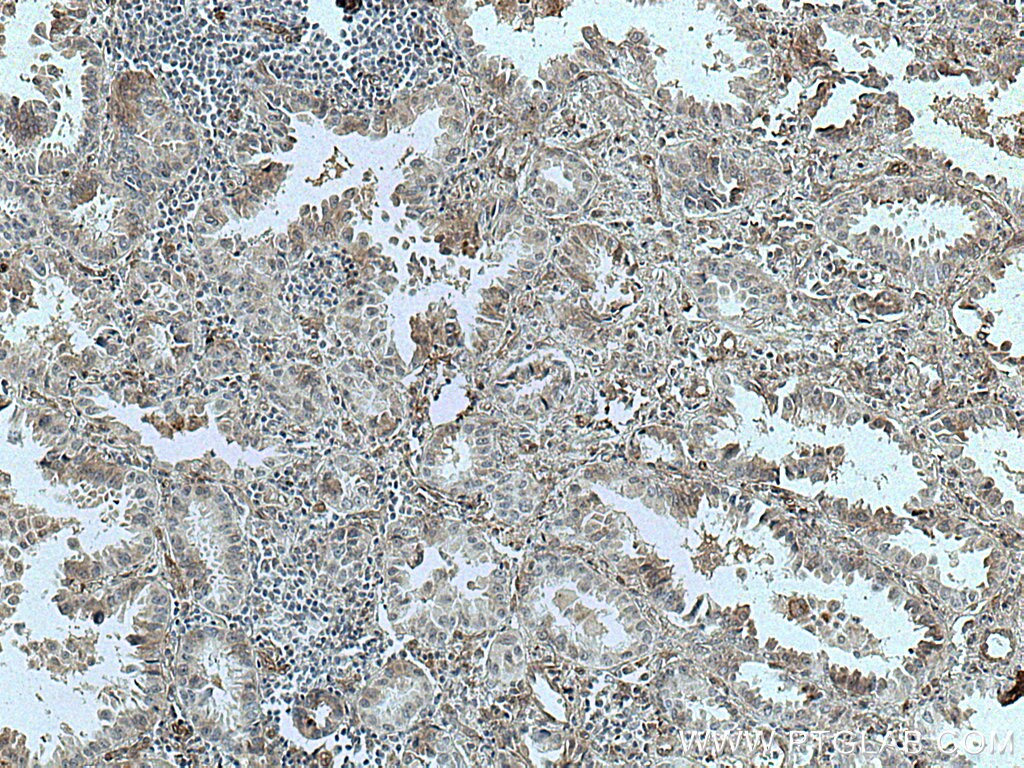 Immunohistochemistry (IHC) staining of human lung cancer tissue using NFAM1 Polyclonal antibody (14310-1-AP)