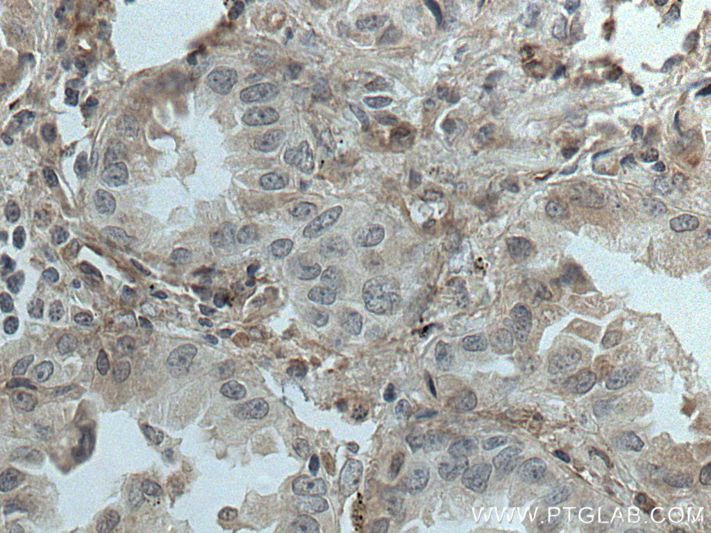 Immunohistochemistry (IHC) staining of human lung cancer tissue using NFAM1 Polyclonal antibody (14310-1-AP)