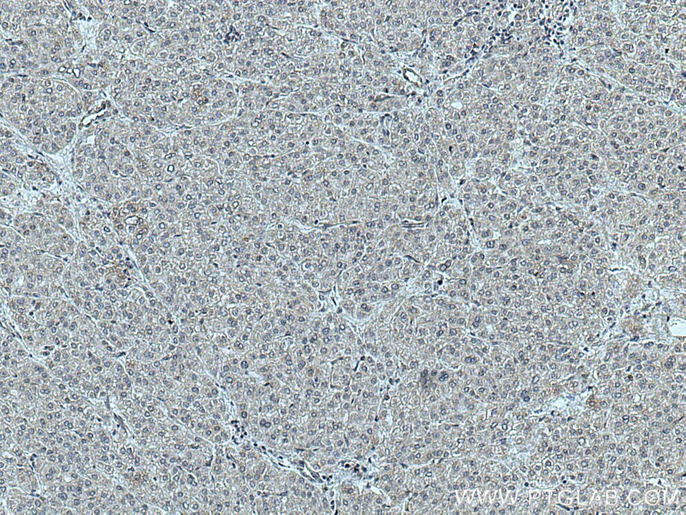 Immunohistochemistry (IHC) staining of human liver cancer tissue using NFAM1 Polyclonal antibody (14310-1-AP)