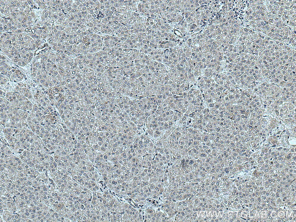 IHC staining of human liver cancer using 14310-1-AP