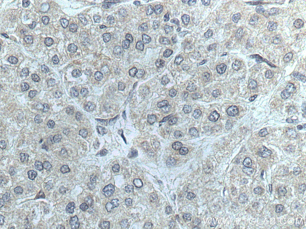 IHC staining of human liver cancer using 14310-1-AP